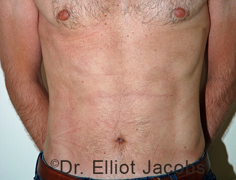 Male body, after Torsoplasty treatment, front view, patient 31