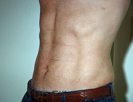 Male body, after Torsoplasty treatment, l-side oblique view, patient 31