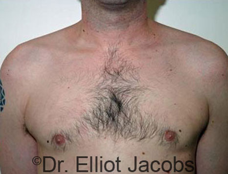 Male breast, after Gynecomastia treatment, front view, patient 29