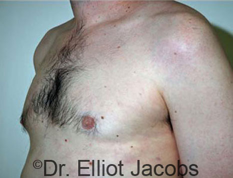 Male breast, after Gynecomastia treatment, l-side oblique view - patient 29