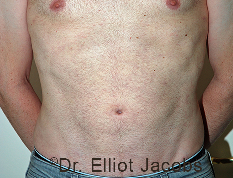 Male body, after Torsoplasty treatment, front view, patient 32