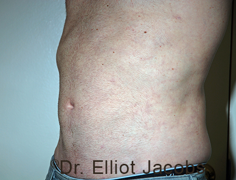 Male body, after Torsoplasty treatment, l-side oblique view, patient 32