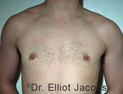 Gynecomastia. Male breast, after FTM Top Surgery treatment, front view, patient 11