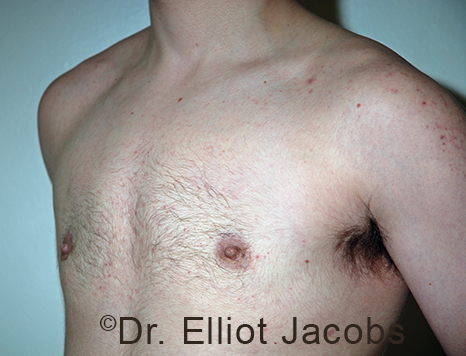 Gynecomastia. Male breast, after FTM Top Surgery treatment, l-side oblique view, patient 11