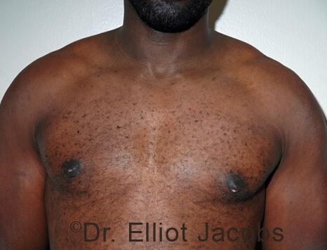 Male breast, after Gynecomastia treatment, front view, patient 106