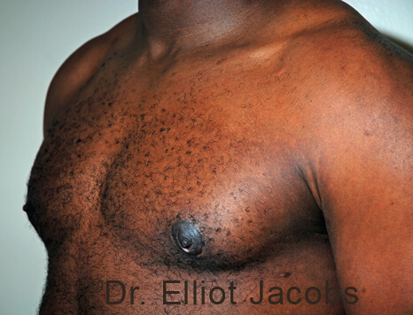 Male breast, after Gynecomastia treatment, l-side oblique view - patient 106