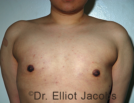 Gynecomastia. Male breast, after FTM Top Surgery treatment, front view, patient 12