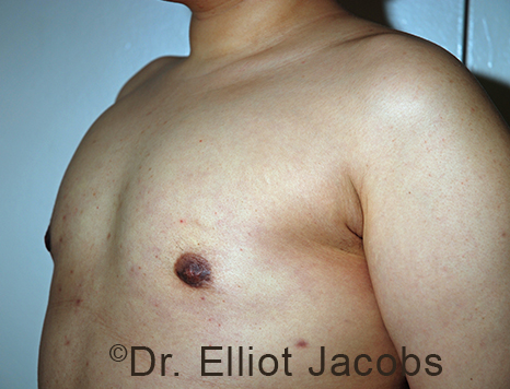 Gynecomastia. Male breast, after FTM Top Surgery treatment, l-side oblique view, patient 12