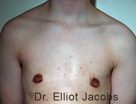 Gynecomastia. Male breast, after FTM Top Surgery treatment, front view, patient 13