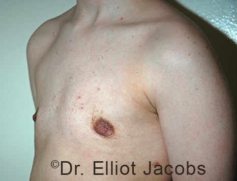 Gynecomastia. Male breast, after FTM Top Surgery treatment, l-side oblique view, patient 13