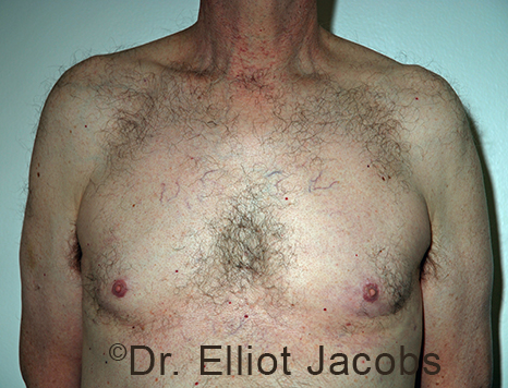 Male breast, after Gynecomastia treatment, front view, patient 107