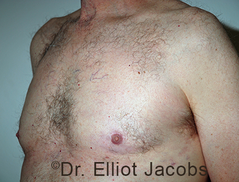 Male breast, after Gynecomastia treatment, l-side oblique view - patient 107