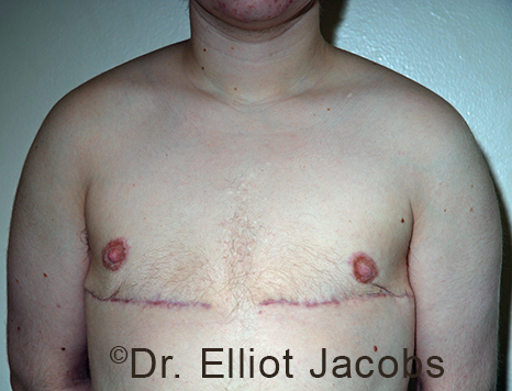 Gynecomastia. Male breast, after FTM Top Surgery treatment, front view, patient 14