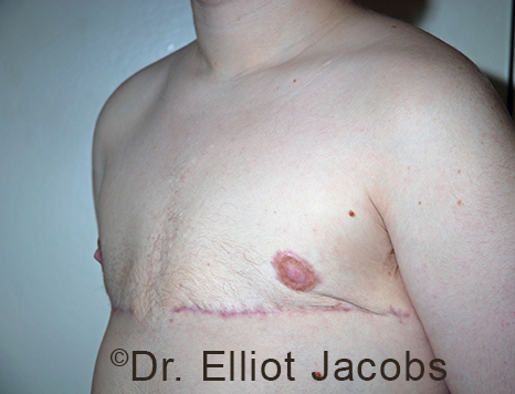 Gynecomastia. Male breast, after FTM Top Surgery treatment, l-side oblique view, patient 14