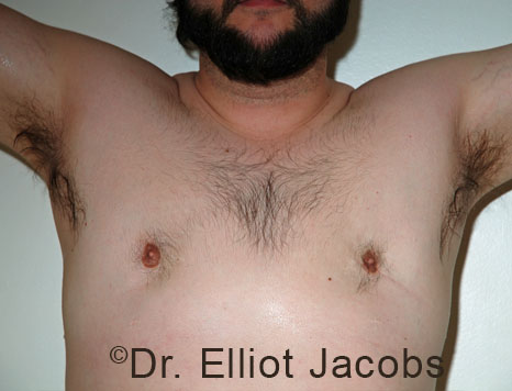 Men's breast, after Crater Deformity Repair treatment, front view - patient 5