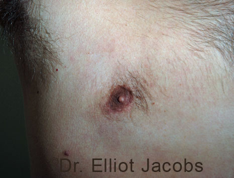Men's breast, after Crater Deformity Repair treatment, front view, patient 5