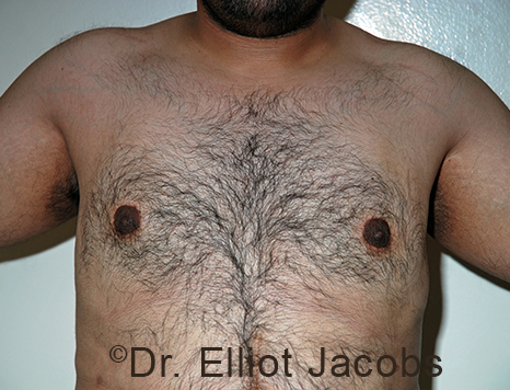 Male breast, after Gynecomastia treatment, front view, patient 108