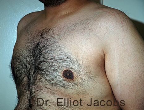 Male breast, after Gynecomastia treatment, l-side oblique view - patient 108