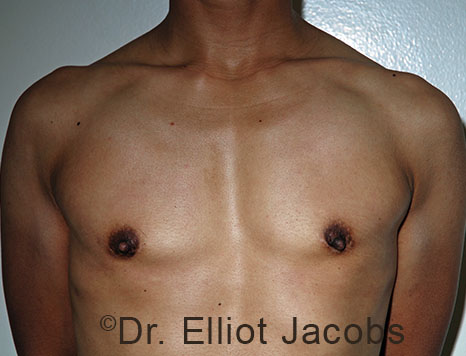 Gynecomastia. Male breast, after FTM Top Surgery treatment, front view, patient 15