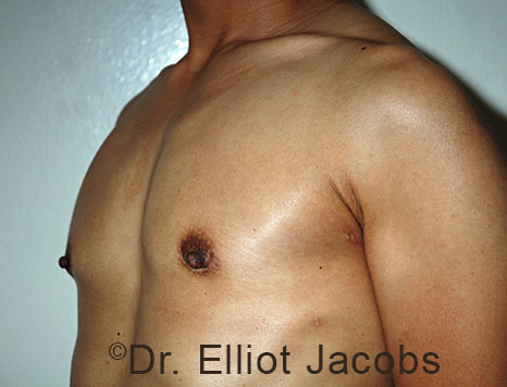 Gynecomastia. Male breast, after FTM Top Surgery treatment, l-side oblique view, patient 15