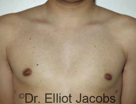 Male breast, after Gynecomastia treatment, front view, patient 3