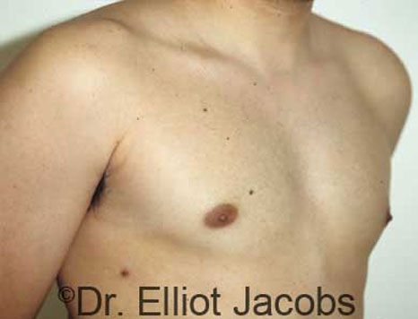 Male breast, after Gynecomastia treatment, r-side oblique view, patient 3