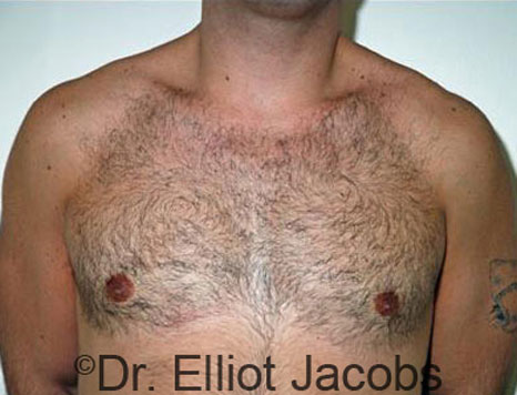 Male breast, after Gynecomastia treatment, front view, patient 30