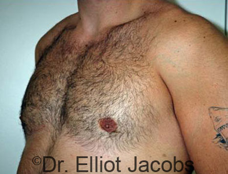 Male breast, after Gynecomastia treatment, l-side oblique view - patient 30