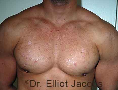 Male breast, after Gynecomastia treatment, front view, patient 109