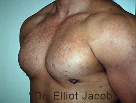 Male breast, after Gynecomastia treatment, l-side oblique view - patient 109