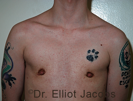 Gynecomastia. Male breast, after FTM Top Surgery treatment, front view, patient 16