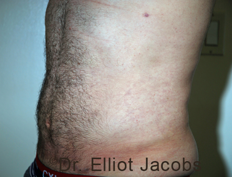 Male body, after Torsoplasty treatment, l-side oblique view, patient 33
