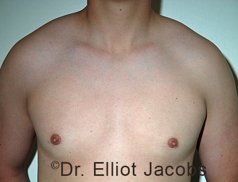 Men's breast, after Gynecomastia Adolescent treatment, front view - patient 37