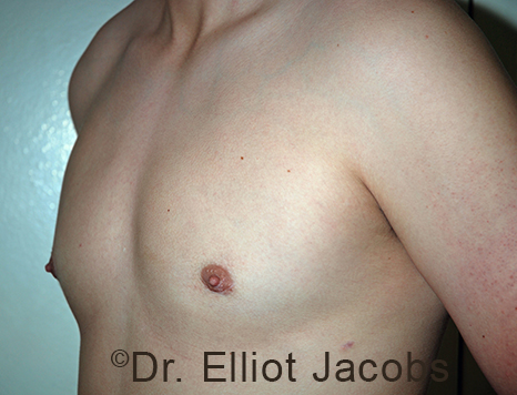 Men's breast, after Gynecomastia Adolescent treatment, oblique view - patient 37