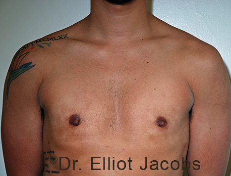 Gynecomastia. Male breast, after FTM Top Surgery treatment, front view, patient 17