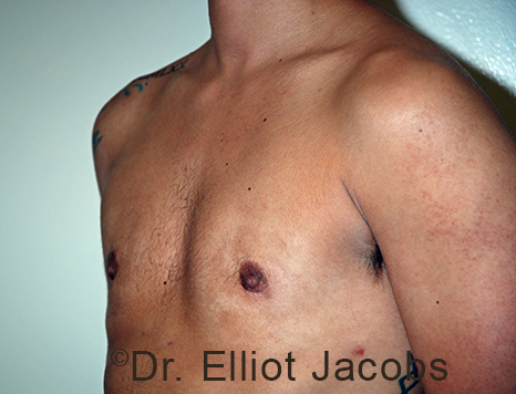 Gynecomastia. Male breast, after FTM Top Surgery treatment, l-side oblique view, patient 17