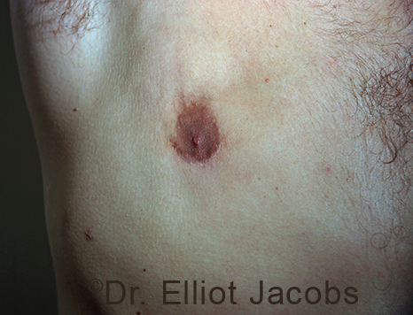 Men's nipple, after Revision Gynecomastia treatment, front view - patient 3