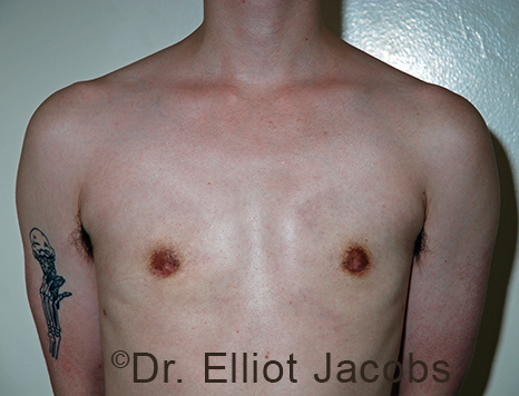 Gynecomastia. Male breast, after FTM Top Surgery treatment, front view, patient 18