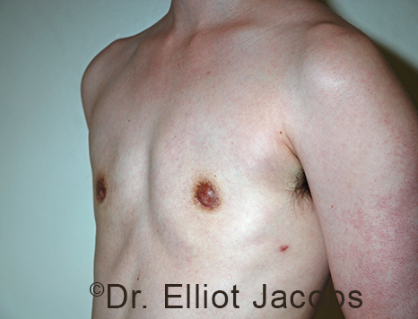 Gynecomastia. Male breast, after FTM Top Surgery treatment, l-side oblique view, patient 18