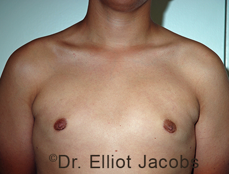 Men's breast, after Gynecomastia Adolescent treatment, front view - patient 38