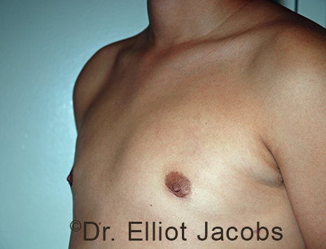 Men's breast, after Gynecomastia Adolescent treatment, oblique view - patient 38