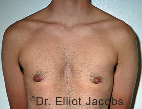 Gynecomastia. Male breast, after FTM Top Surgery treatment, front view, patient 19