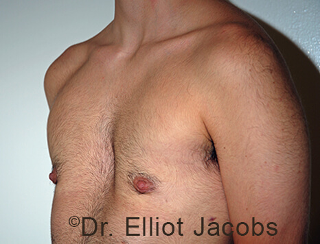 Gynecomastia. Male breast, after FTM Top Surgery treatment, l-side oblique view, patient 19