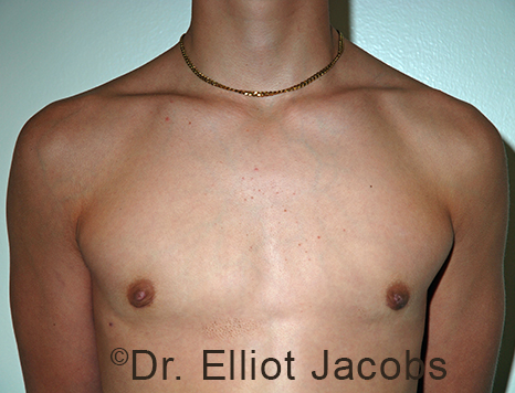Men's breast, after Gynecomastia Adolescent treatment, front view - patient 39
