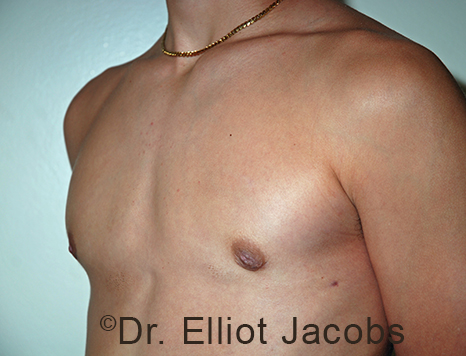 Men's breast, after Gynecomastia Adolescent treatment, oblique view - patient 39