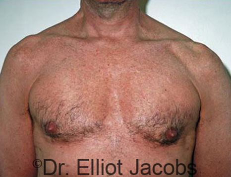Male breast, after Gynecomastia treatment, front view, patient 31