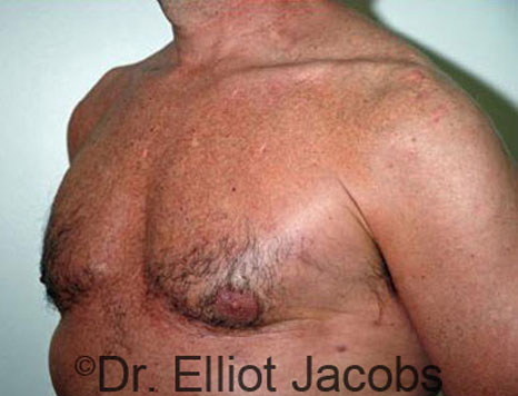 Male breast, after Gynecomastia treatment, l-side oblique view - patient 31
