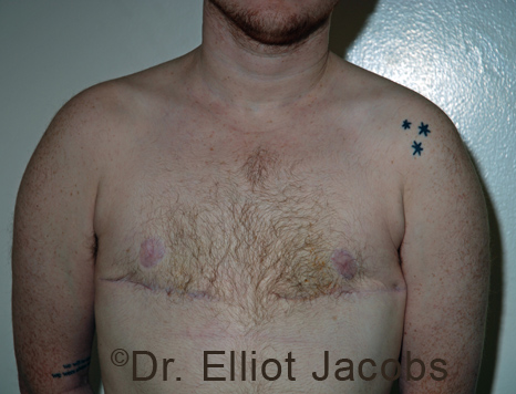 Gynecomastia. Male breast, after FTM Top Surgery treatment, front view, patient 20