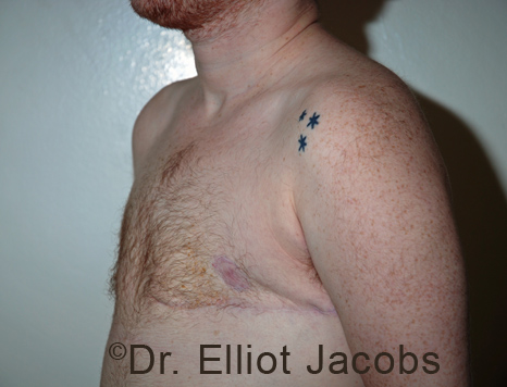 Gynecomastia. Male breast, after FTM Top Surgery treatment, l-side oblique view, patient 20