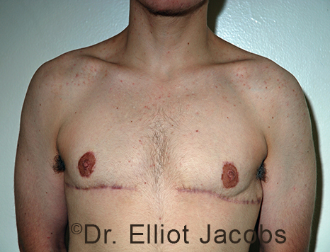 Gynecomastia. Male breast, after FTM Top Surgery treatment, front view, patient 24